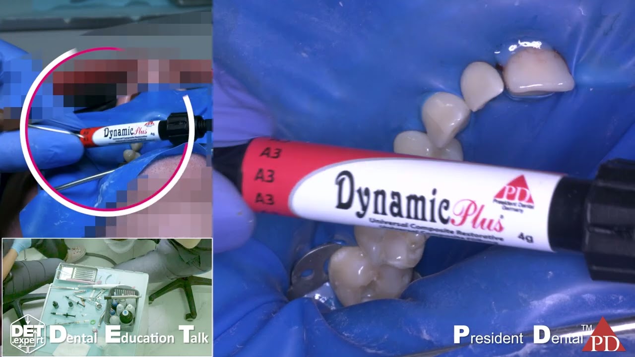 #PresidentDental кариес 14, 15, 16 класс II #Stark #dynamicplusClinical Case DET.expert 003 4K