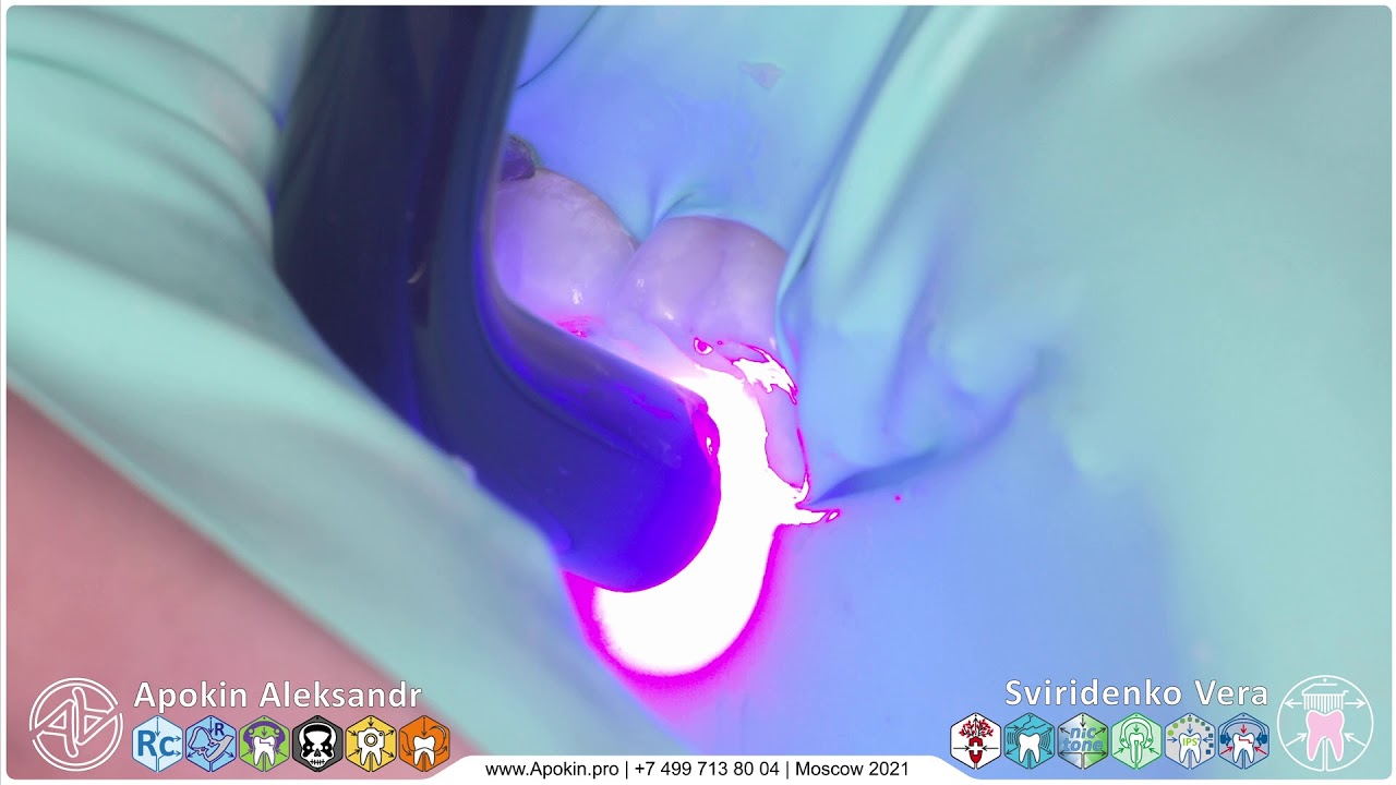 Caries 36 37 FissurCst Nictone TorVM (4K LiveStram)