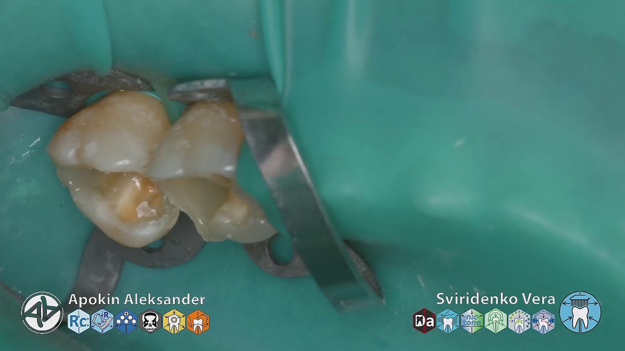 Caries Class — II EvoCeram Sanctuary TorVM Ul-Amin  (FHD multistream)