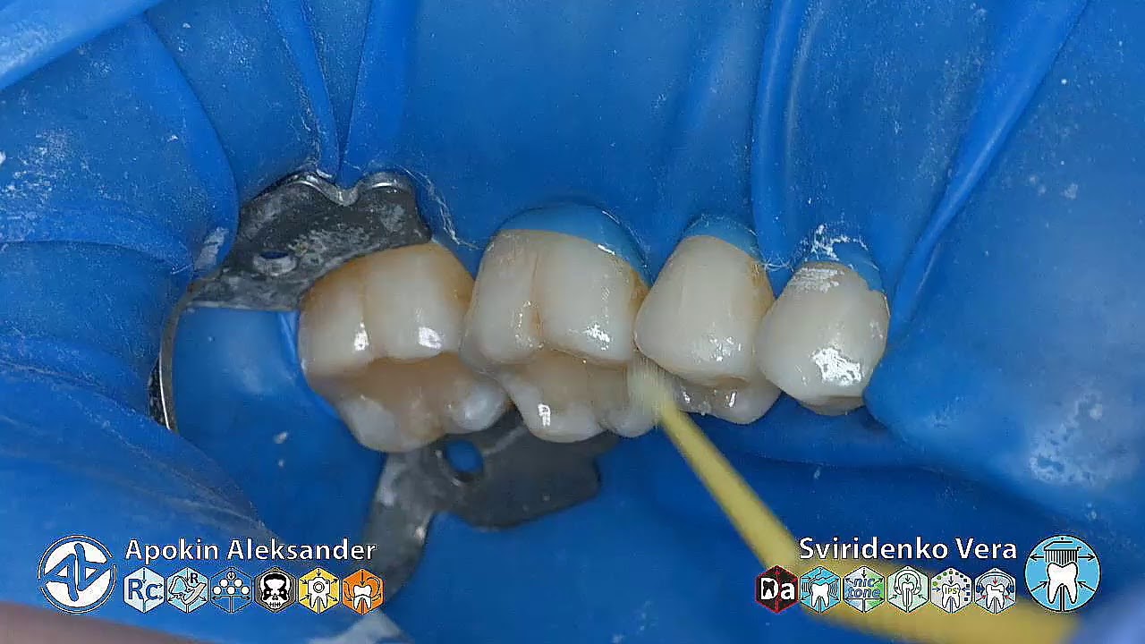 Caries class-I 36 35 34 Ivoclar EvoCeram Syntac Sanctuary FABRI TorVM (multistream)