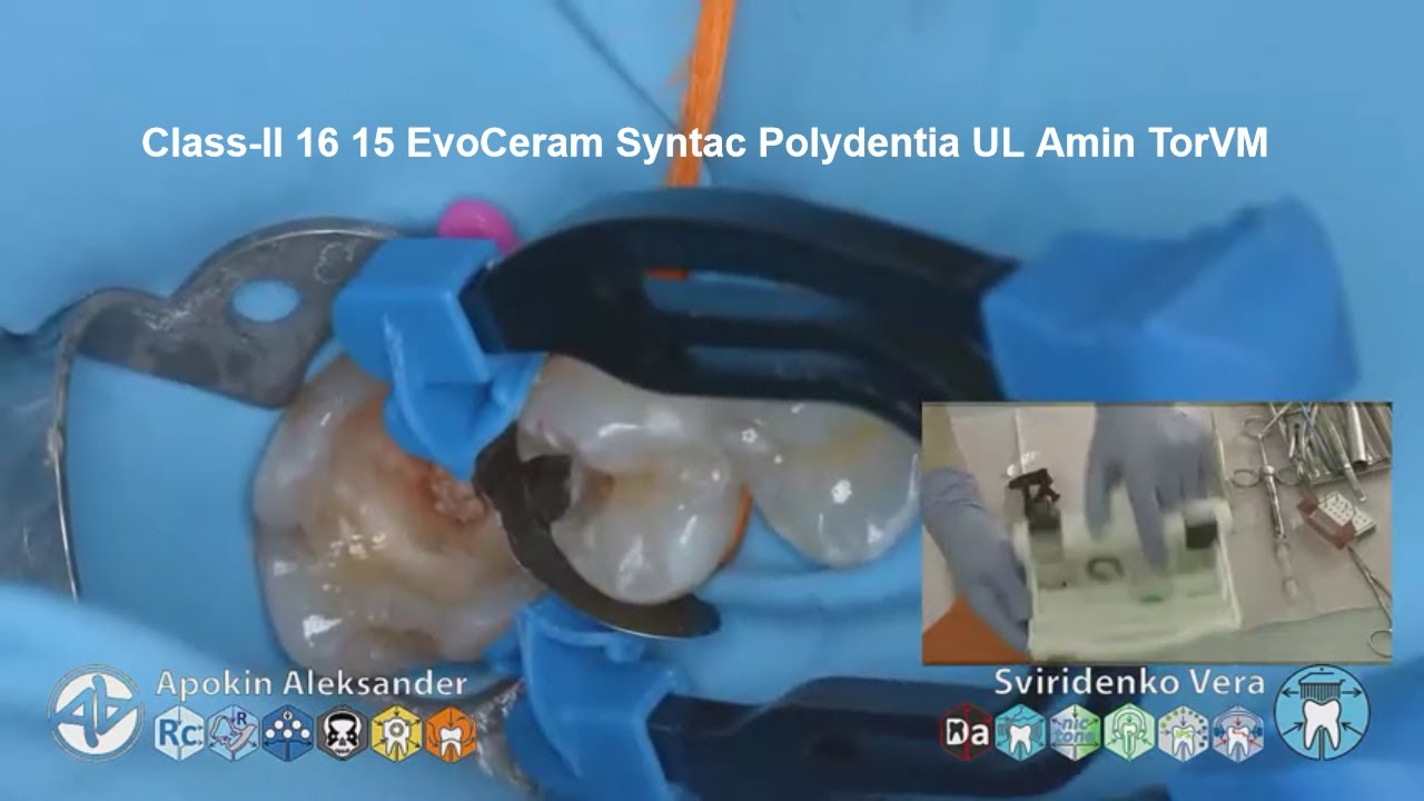 Caries class-II 16 15 EvoCeram Syntac Polydentia UL Amin TorVM (FHD multistream)