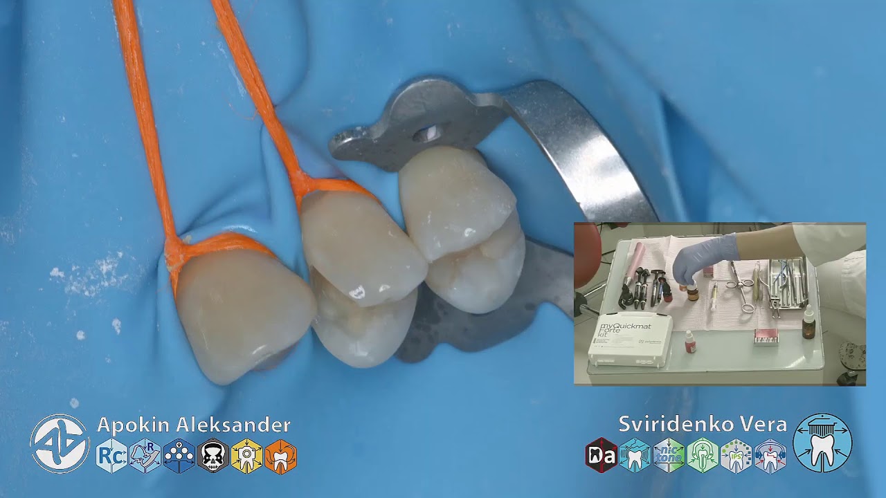 Caries class-II 24 EvoCeram Syntac Sanctuary LM-Arte TorVM (FHD multistream)