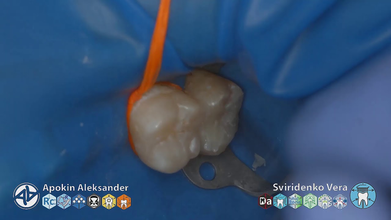 Caries class II 27 Fissur-cast EvoCeram Syntac Polydentia Sanctuary TorVM (FHD multistream)