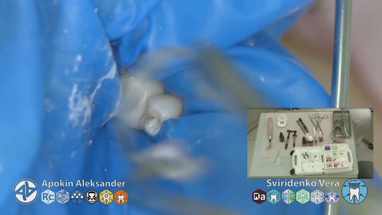 Caries class-II 35 EvoCeram Syntac Polydentia Sanctuary TorVM (FHD multistream)