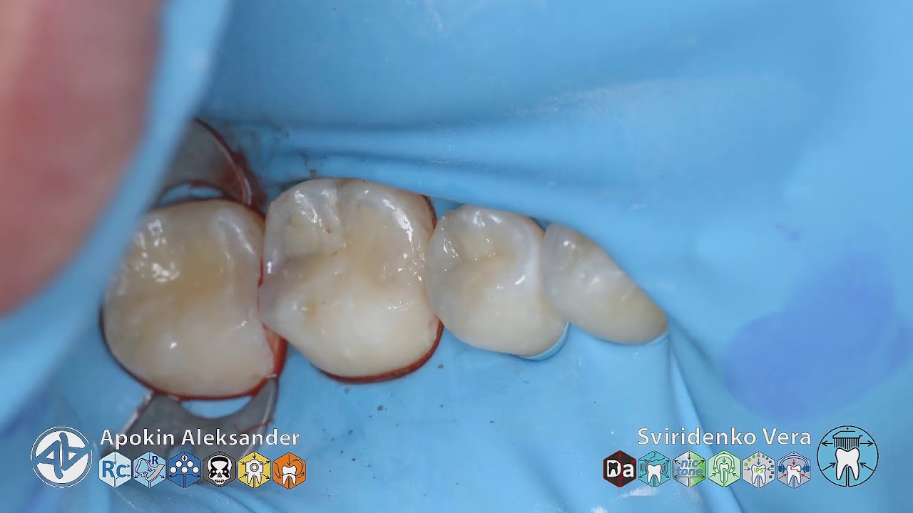 Caries class-II 45 46 EvoCeram Syntac Sanctuary UL AMIN TorVM (FHD multistream)