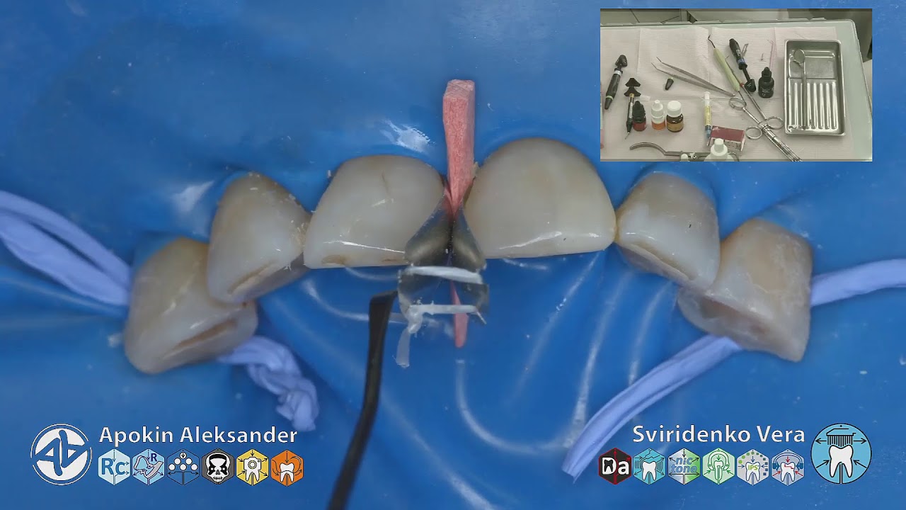 Caries class-IV 12 11 21 Syntac EmpressDirect Sanctuary UL Amin TorVM (FHD multistream)