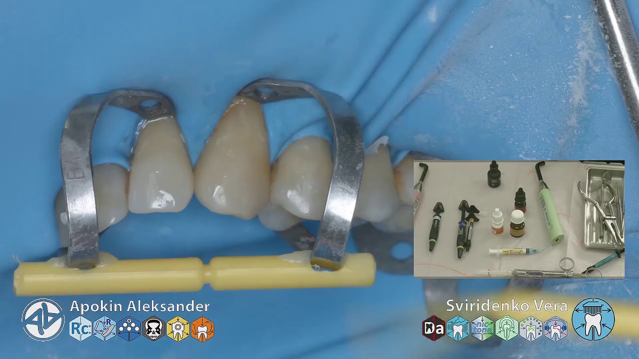 Caries class — V 25 24 EmpressDirect Syntac Nictone TorVM (FHD multistream)