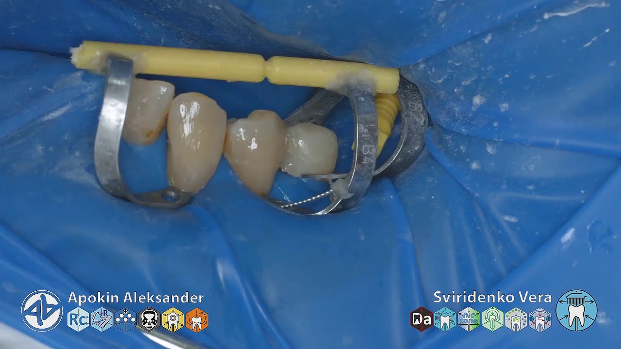 Caries class -V 34 33 EvoCeram Syntac Sanctuary UL AMIN TorVM  (FHD multistream)