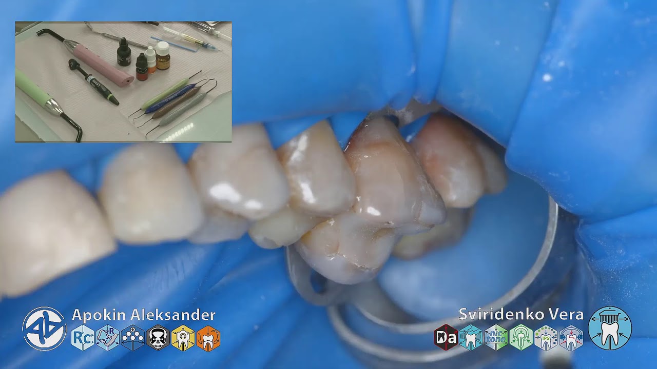 Caries class-V of 26 EvoCeram Syntac Sanctuary TorVM (FHD multistream)