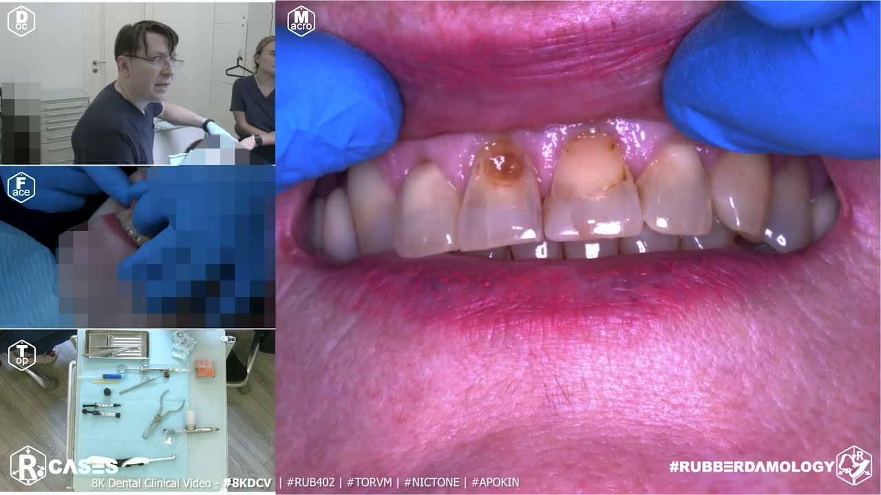 Frontal tooth isolation 15-25 with #nictone #Rubberdamology #8kdcv #8k #TorVM #rub301 #Apokin