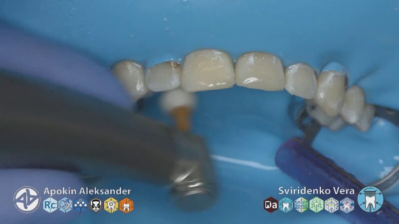Orthodontics-maxilar-retainer-fixation-Syntac-Tetric-N-Flow-Nictone-TorVM-FHD-multistream