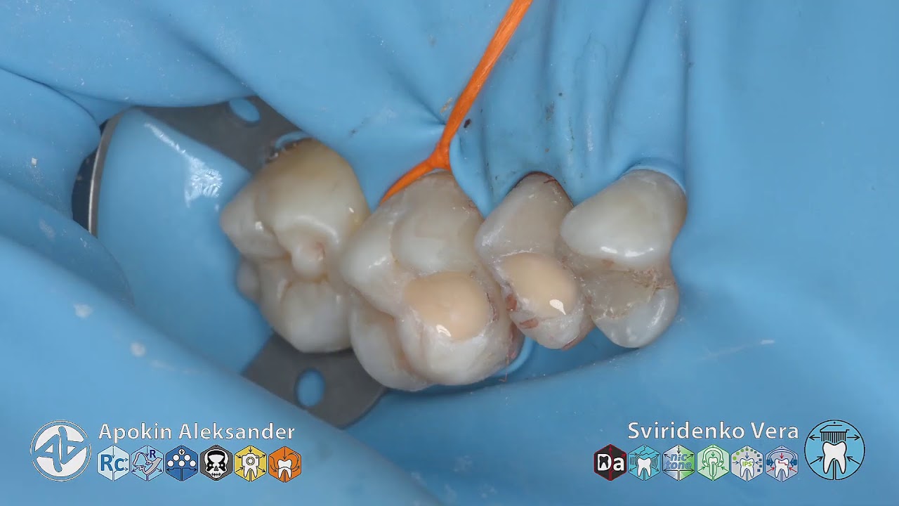 Preendodontics BuildUP 15 16 EvoCeram Syntac FABrI Sanctuary Polydentia TorVM (FHD multistream)