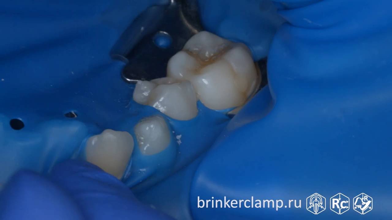 Rubberdam case 124 Caries V-Class Brinker B4 TorVM