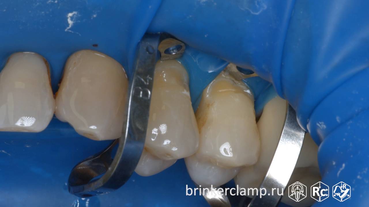 Rubberdam case 127 Caries V-Class Brinker B4 TorVM