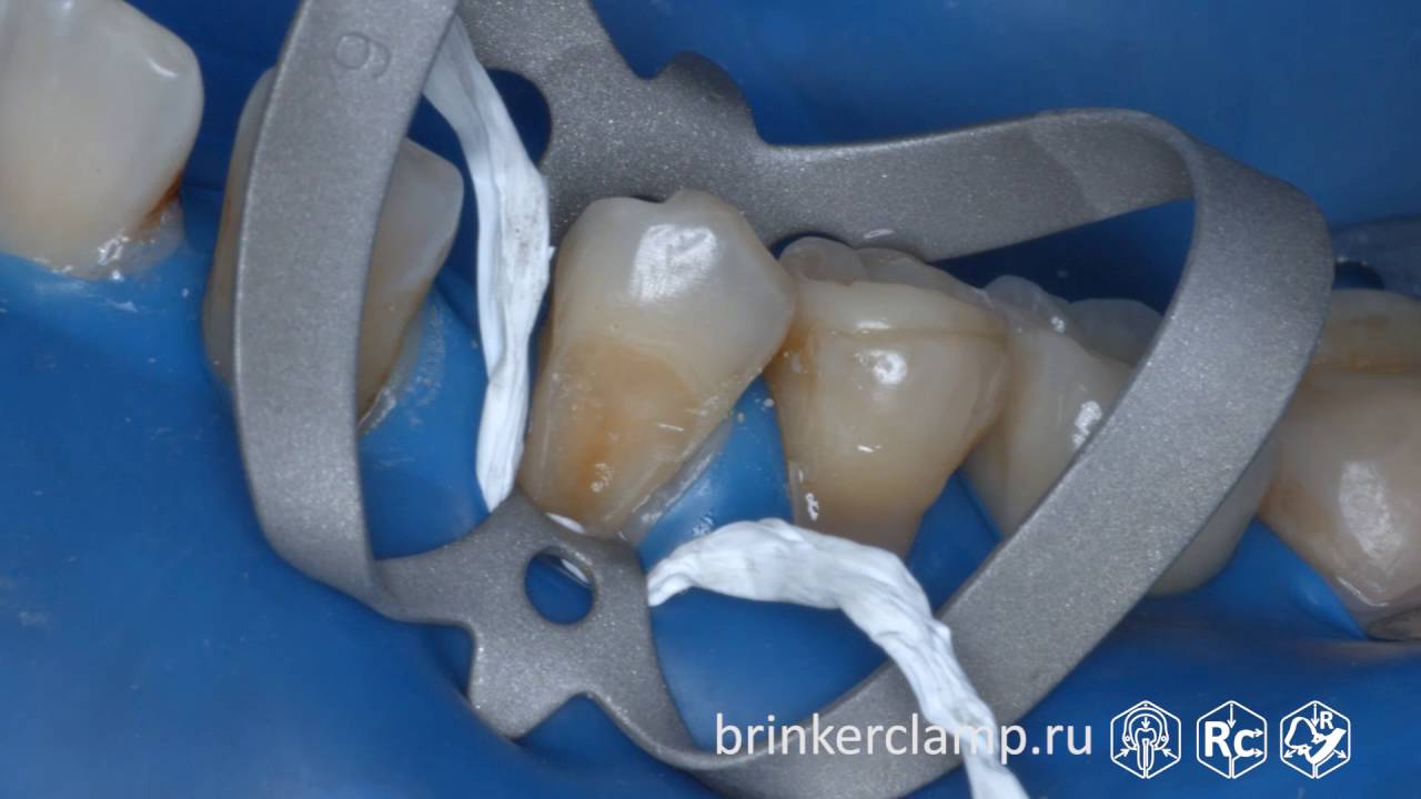 Rubberdam case 128 Caries V-Class Brinker B4 TorVM