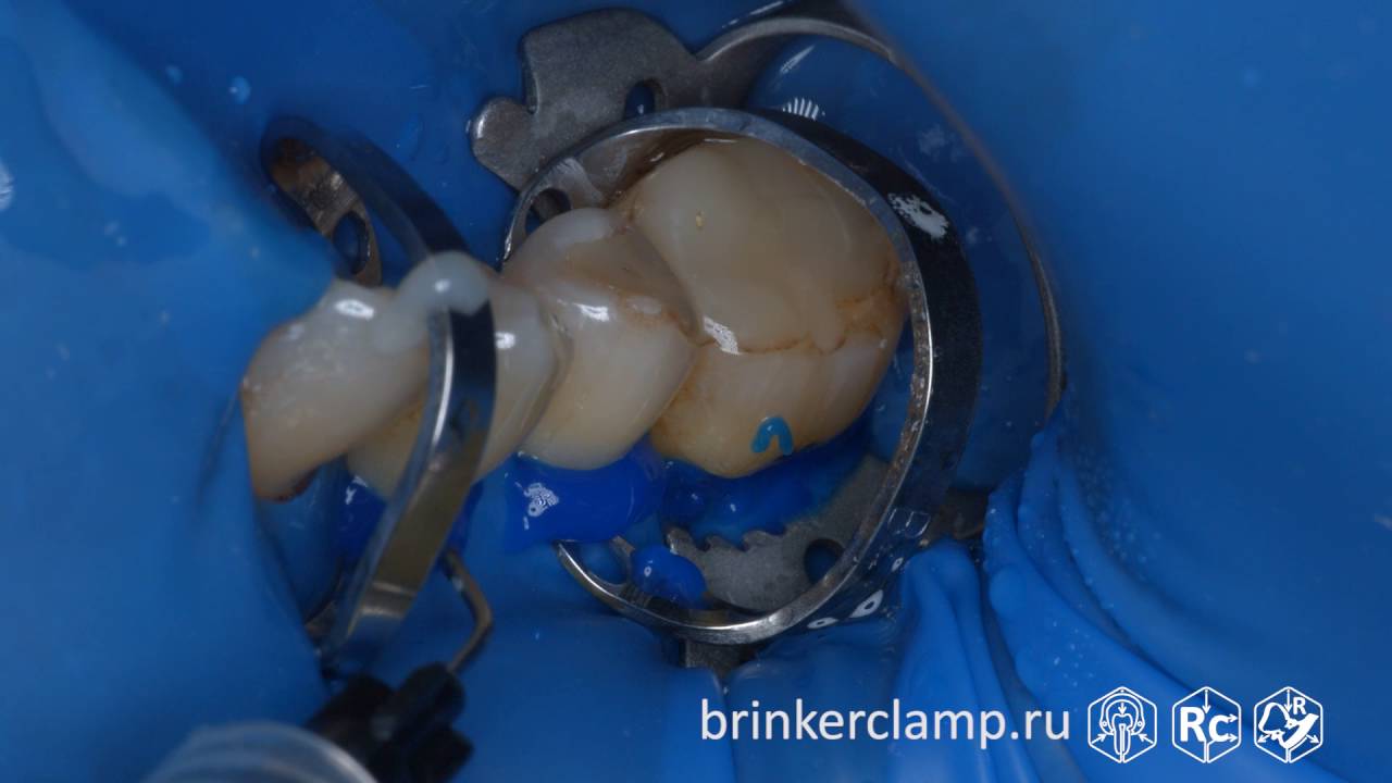 Rubberdam case 129 Caries V-Class Brinker B4 TorVM