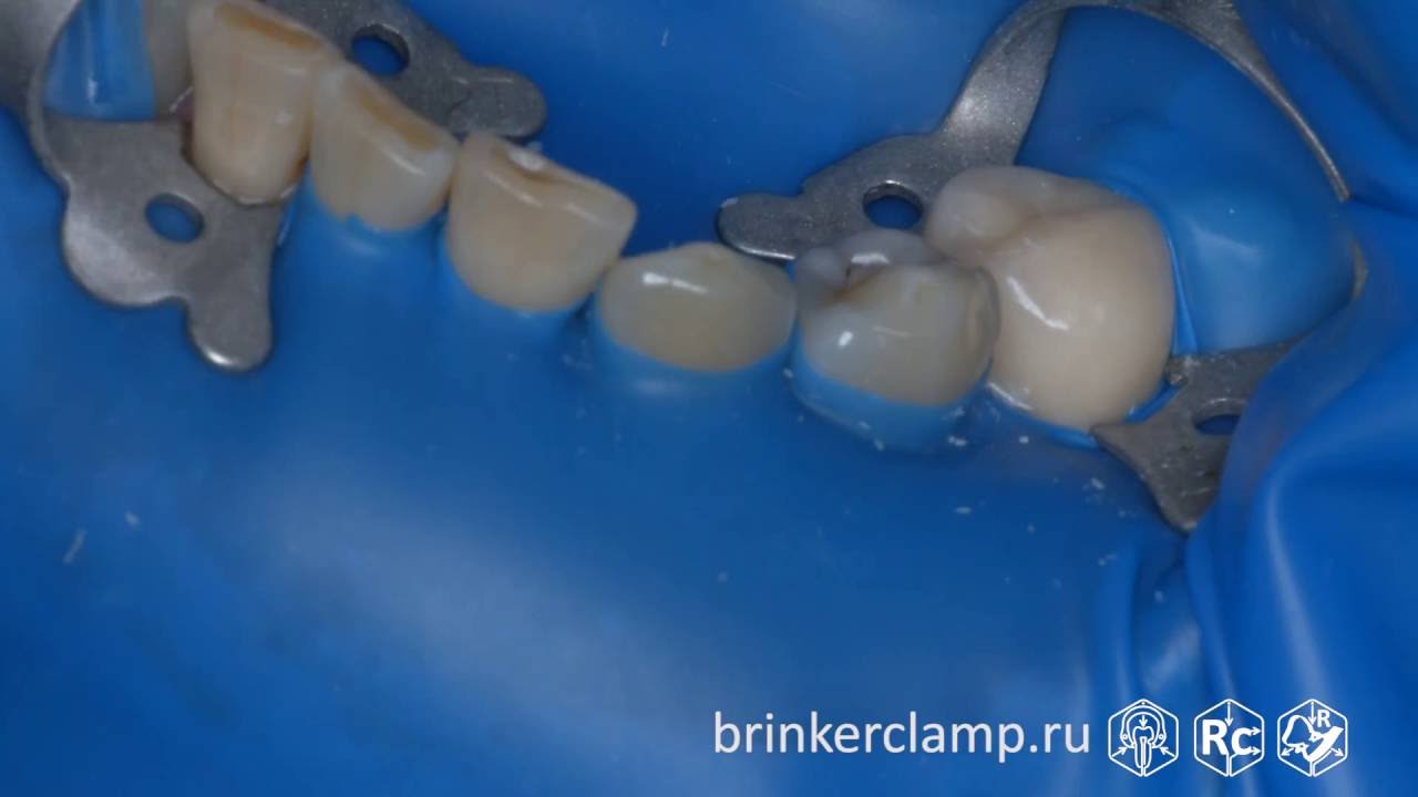 Rubberdam case 137 Caries V-Class Brinker B4 TorVM