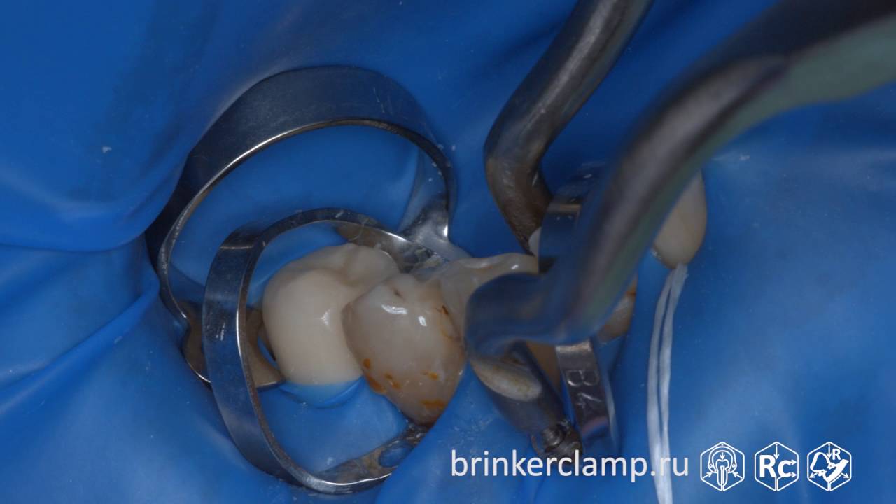 Rubberdam case 138 Caries V-Class Brinker B4 TorVM