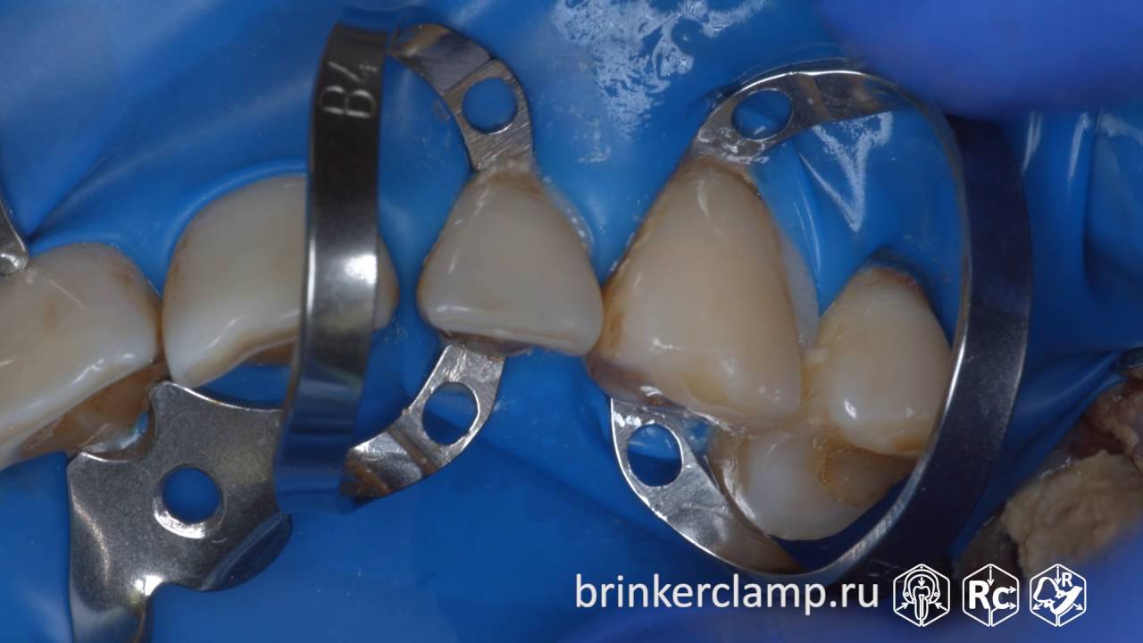 Rubberdam case 140 Caries V-Class Brinker B4 TorVM