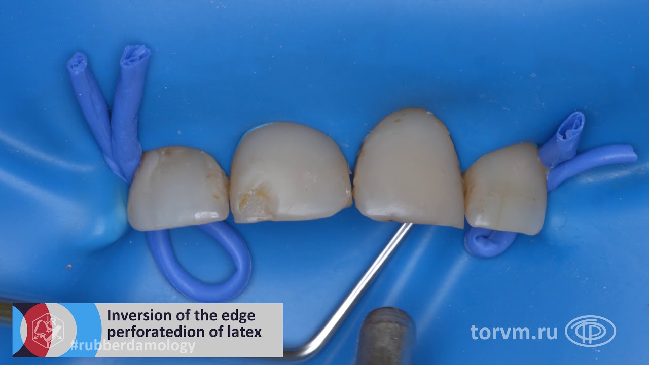 TorVM Clamp 9 Aplication 002 rubberdamology ENG 4K