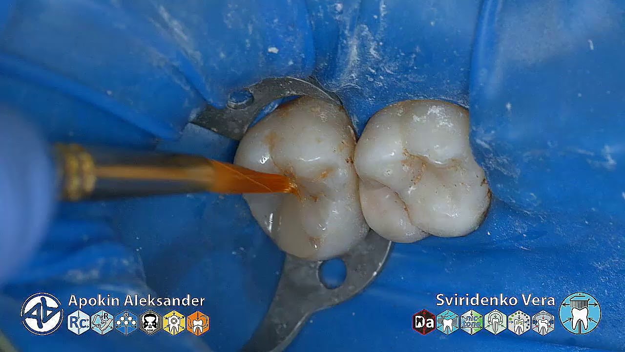 Distal caries 17 EvoCaram Sanctuary TorVM FABRI (мультистрим)