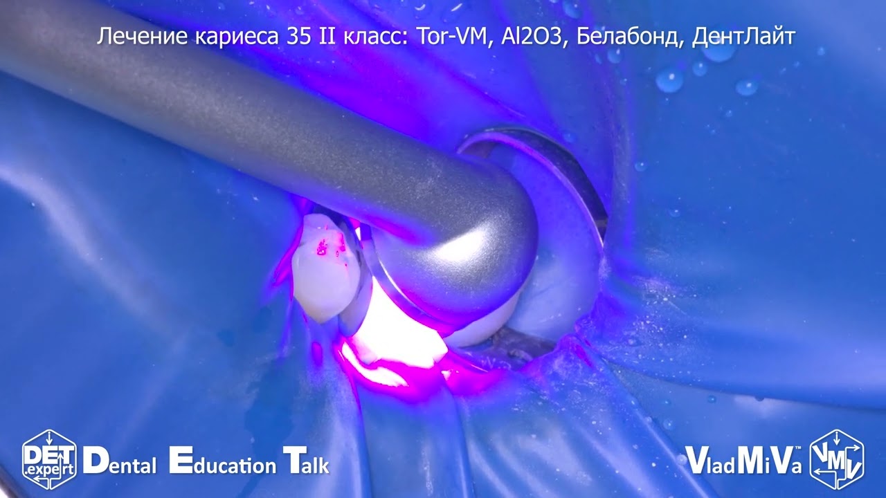 Лечение кариеса 35 II класс: Tor-VM, Al2O3, Белабонд, ДентЛайт DET.expert & Vladmiva 4K