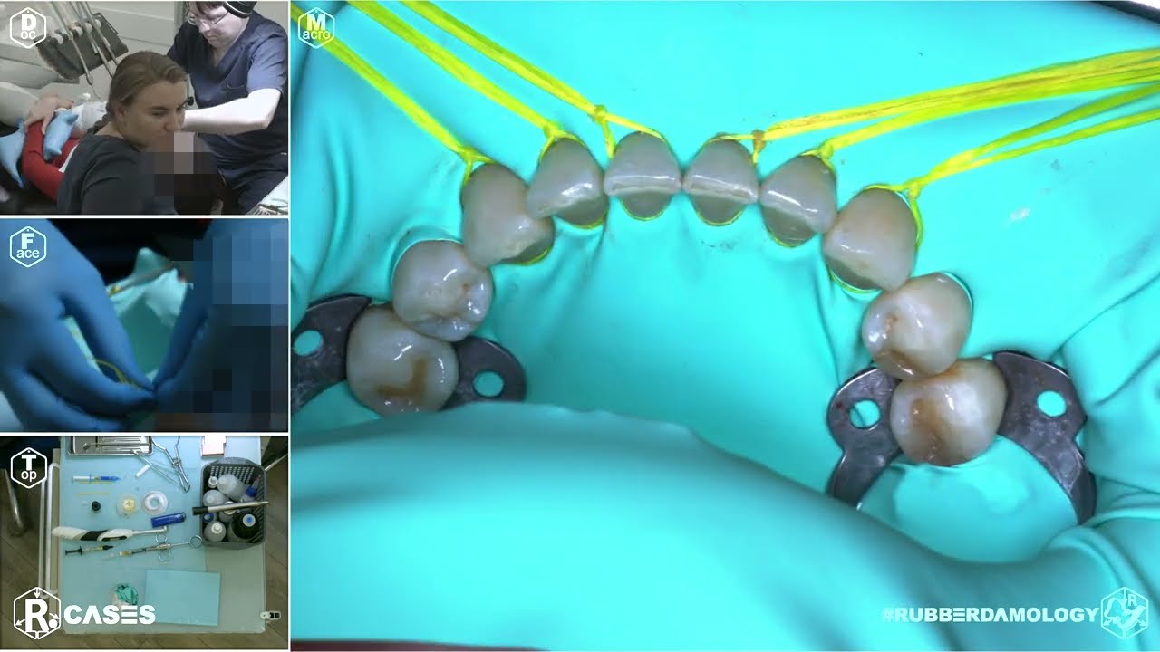 #rubberdamology #4CAMcase #8KDCV Case 001 —  isolation for retainer fixation #Nictone #rub101 #8K