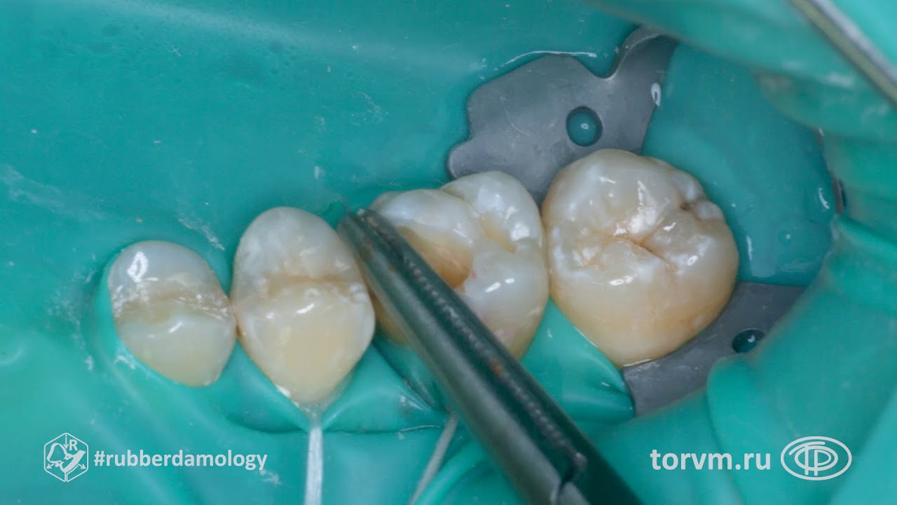 #rubberdamology TorVM Matrix Aplication 001 03 ENG